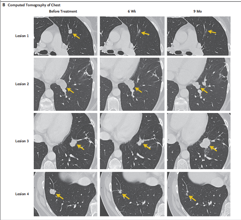 圖2?患者轉(zhuǎn)移病灶的變化情況