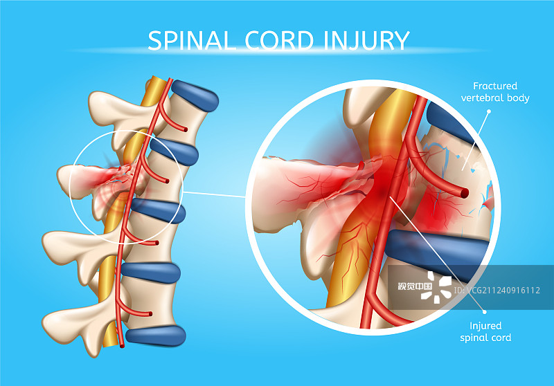 神經(jīng)干細(xì)胞移植在脊髓損傷修復(fù)中的作用及應(yīng)用