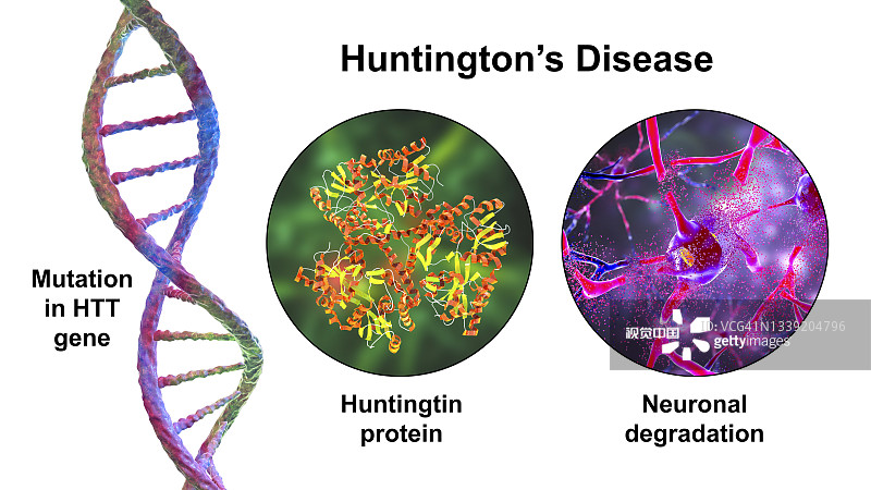 亨廷頓氏病，概念性說(shuō)明