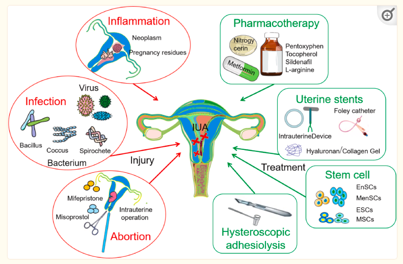 圖1：子宮內膜損傷的機制及主要治療策略。
