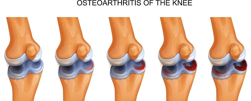 干細胞修復撕裂的無血管半月板軟骨:從體外優化到首次人體研究
