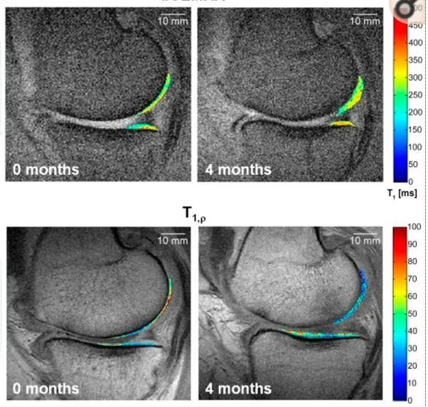 干細(xì)胞療法修復(fù)后疼痛顯著減輕，半月板軟骨質(zhì)量提高。