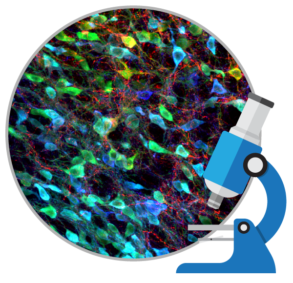 盤點：干細(xì)胞移植治療帕金森病的臨床研究進(jìn)展