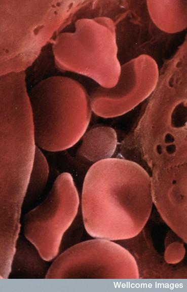 許多血液疾病已經(jīng)可以使用臍帶血進行治療。