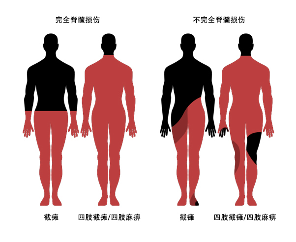 脊髓損傷并發癥