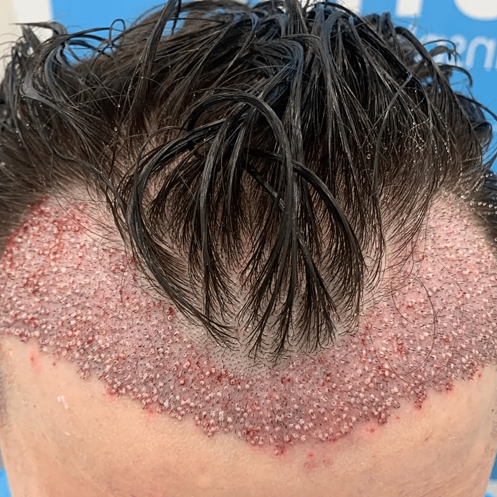 頭發(fā)移植手術(shù)后即刻的結(jié)果。——這允許在患者中建立更豐滿(mǎn)和更前的發(fā)際線