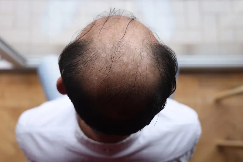 干細(xì)胞治療脫發(fā)的優(yōu)缺點(diǎn)