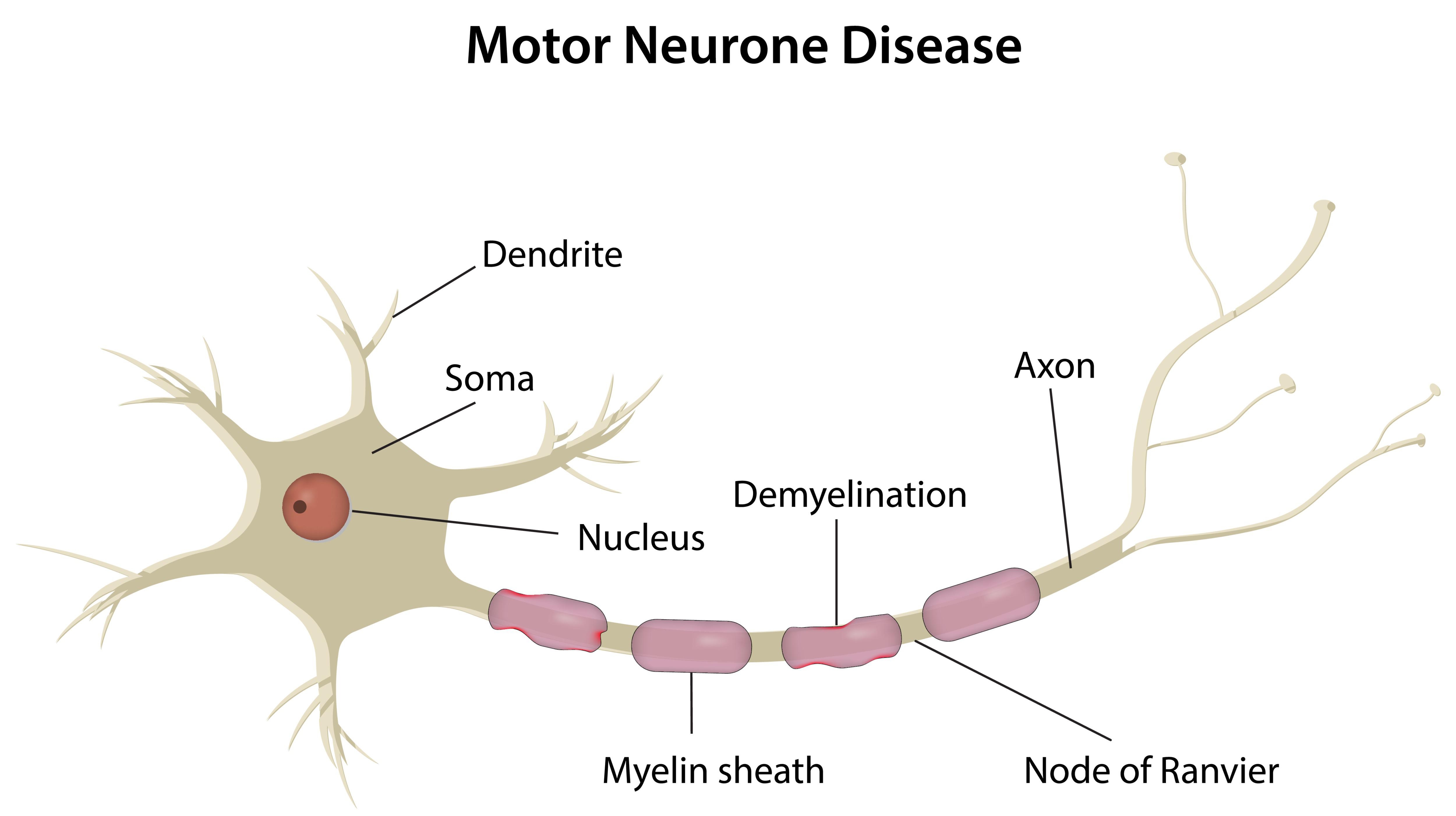 什么是運(yùn)動(dòng)神經(jīng)元病？