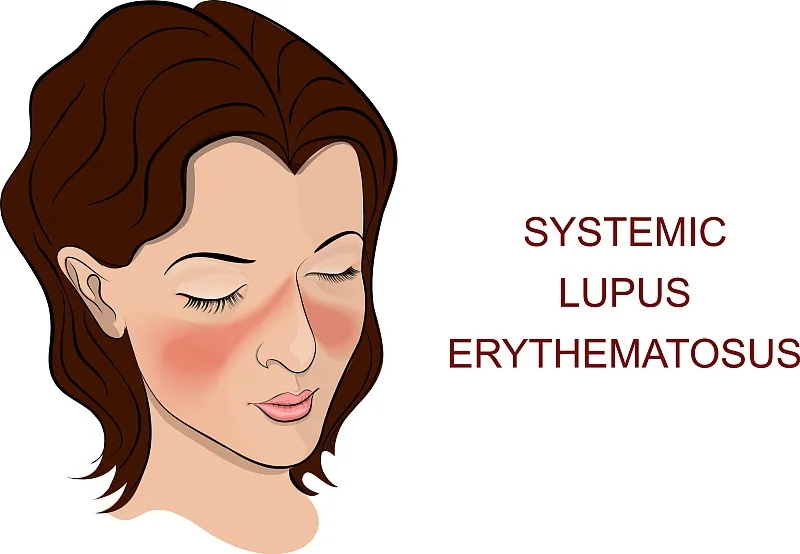 系統性紅斑狼瘡是一種自身免疫性疾病，其特征在于針對細胞核和細胞質抗原的自身抗體