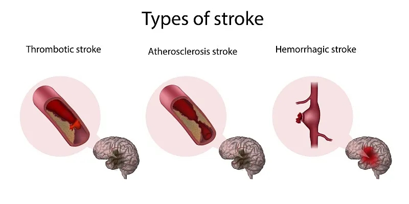 系統(tǒng)評估干細胞療法治療缺血性中風的安全性及可行性