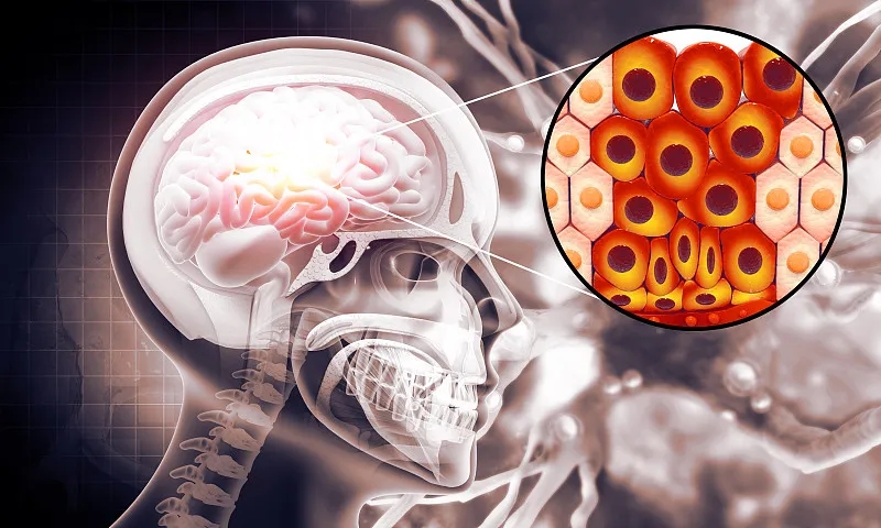 羊膜細胞療法治療缺血性中風患者的I期試驗結果