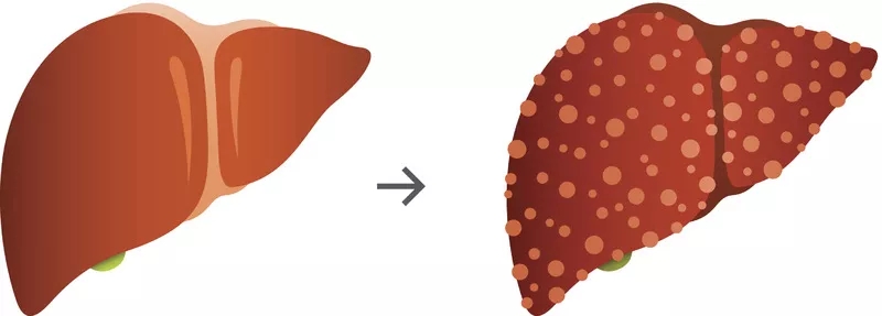 肝硬化的體征和癥狀是什么？及其治療方法