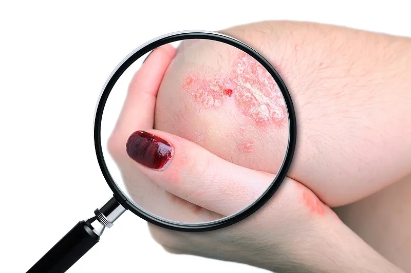 國內已有7項臨床研究項目，干細胞治療銀屑病，未來可期！