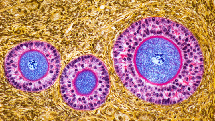 卵巢早衰體征和癥狀是什么？及其治療方法