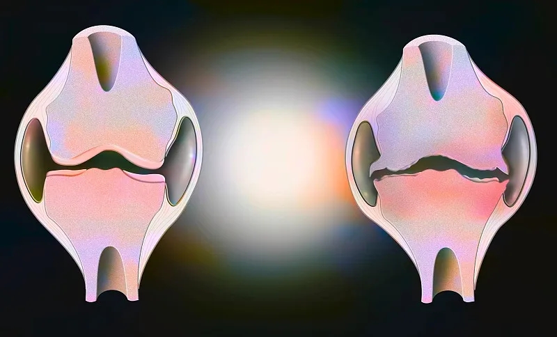 盤點：2020~2023年干細胞治療骨關節炎的臨床研究進展