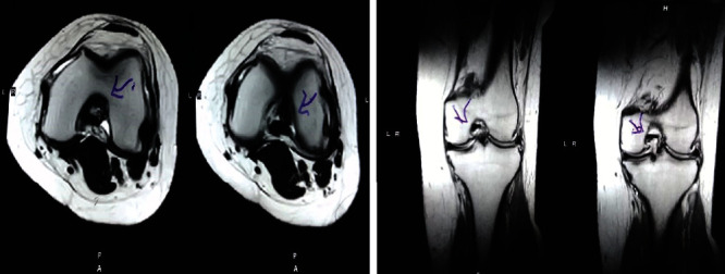 圖2：治療后MRI顯示內側和外側半月板后角的撕裂有所改善。患者經歷了癥狀改善以及進行日常生活活動的能力增強。