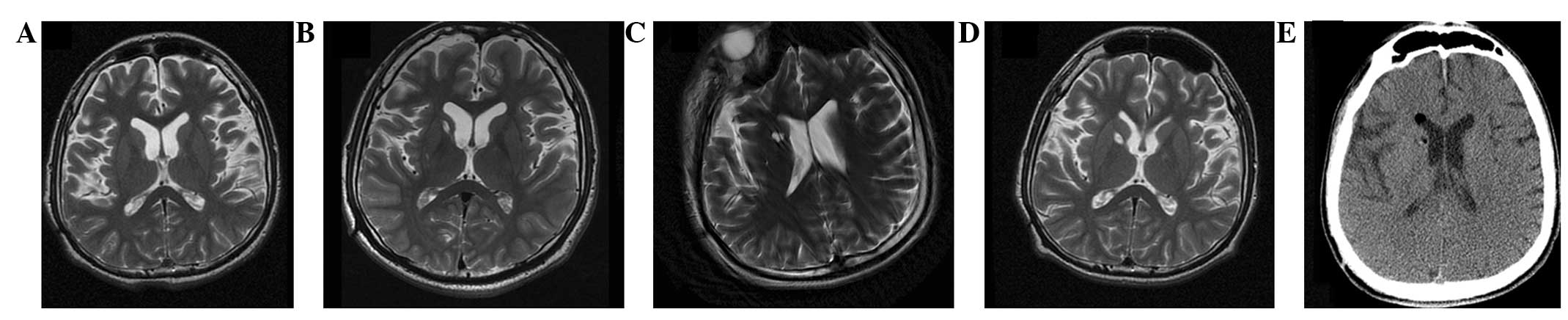 圖2：-T2加權磁共振成像 (MRI)