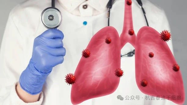 干細胞療法如何減緩肺部疾病的癥狀？