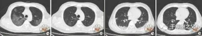 細胞輸注后，炎癥指標改善，復查胸部CT提示雙肺病灶較前吸收，呼吸道癥狀改善，新型冠狀病毒核酸檢測連續2次陰性，治愈出院。