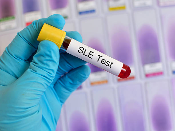 羊膜干細胞移植在系統性紅斑狼瘡中的應用前景