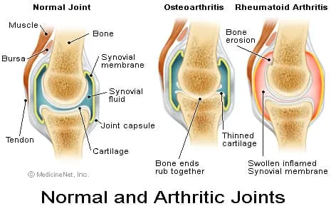 骨關節炎：你真的了解是什么導致你的關節痛嗎？