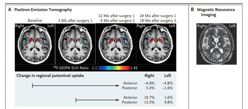 顯示了指示的時間點在基底神經(jīng)節(jié)水平的軸向氟18-L-二羥基苯丙氨酸（18 F-DOPA）正電子發(fā)射斷層掃描圖像