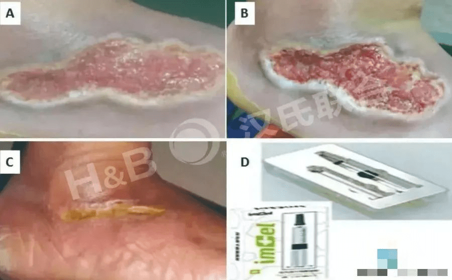 糖尿病足潰瘍患者使用胎盤衍生間充質(zhì)干細胞水凝膠進行三周局部治療：病例報告。