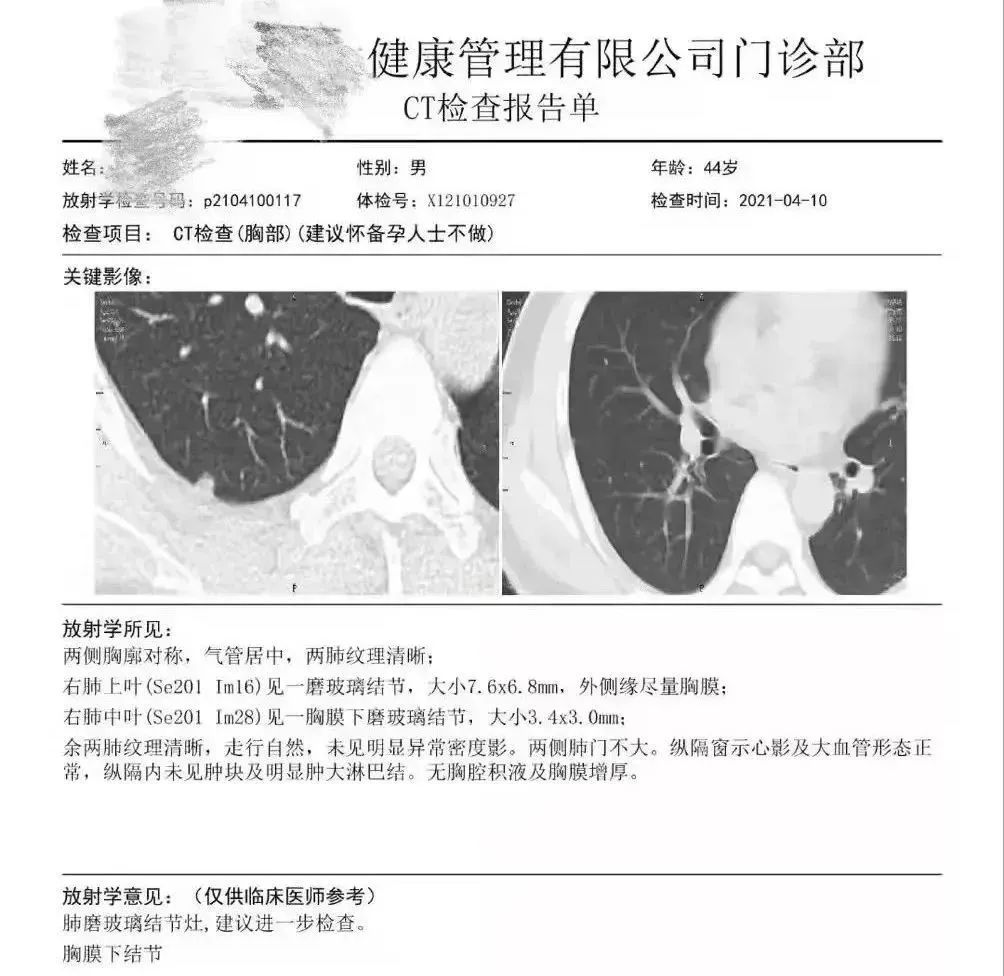 結(jié)果發(fā)現(xiàn)王先生右肺胸膜表面下（肺的內(nèi)部），存在兩枚磨玻璃結(jié)節(jié)，其中較大者直徑7.6mm。