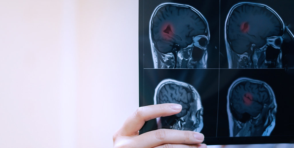 多發性硬化癥的干細胞療法：探索神經免疫學的新前沿