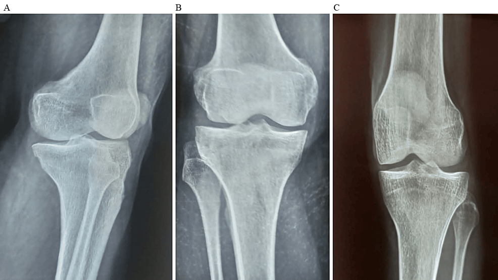 圖2:顯示了開始干細(xì)胞治療后骨骼的側(cè)視圖和前后視圖 圖2:顯示了開始干細(xì)胞治療后骨骼的側(cè)視圖和前后視圖