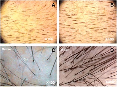 圖3：記錄脂肪干細胞療法后頭發數量增加的照片。移植前（ac）和移植后6個月（bd）頭皮的代表性圖像