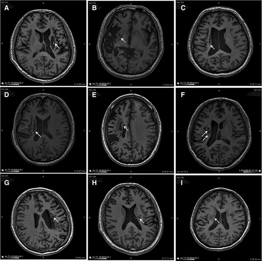 圖3：NSI-566移植后最新隨訪時梗塞部位的MRI。