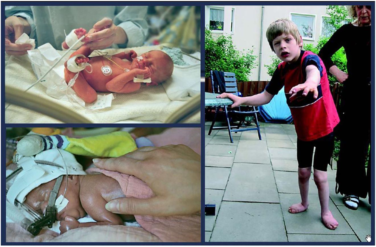 腦癱 (CP) 是兒童期最常見的殘疾，是一種嚴重的非進行性嬰幼兒腦部疾病，具有終身后遺癥