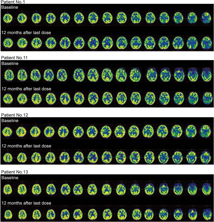圖4：干預(yù)后腦代謝變化。