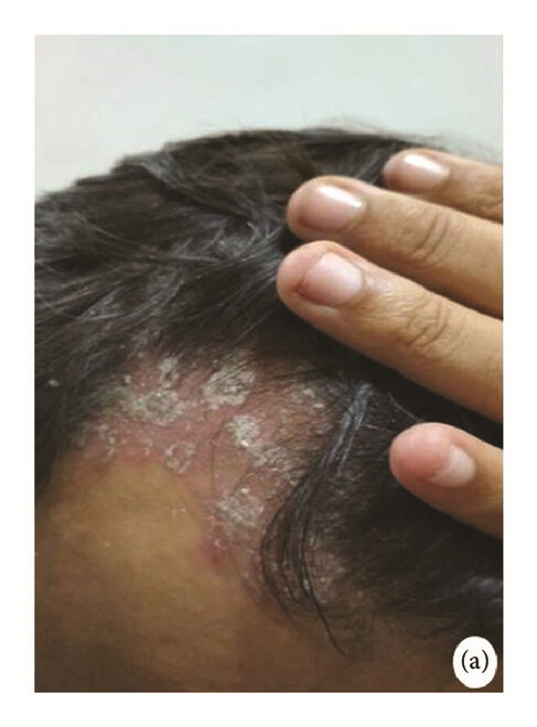 骨髓間充質干細胞 治療前，患者頭皮上出現大量紅斑，并附著銀色鱗片（a）。