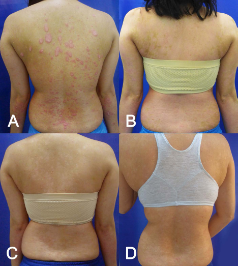 (圖2A）基線（細胞移植前)；(圖2B）首次輸注后 30 天；(圖C2) 121 天后；(圖2D）231 天后。
