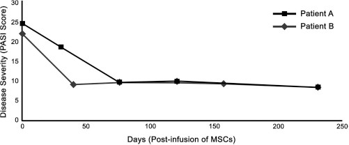 圖 1?. 移植 MSCs 前后兩例患者的銀屑病面積和嚴重程度指數 (PASI) 評分總結。在輸注 MSCs 后的隨訪中，每例患者的 PASI 評分均有所下降。評分由第三方皮膚科醫生進行。臨床改善持久，患者 A 的改善持續超過 150 天，患者 B 的改善持續超過 200 天。