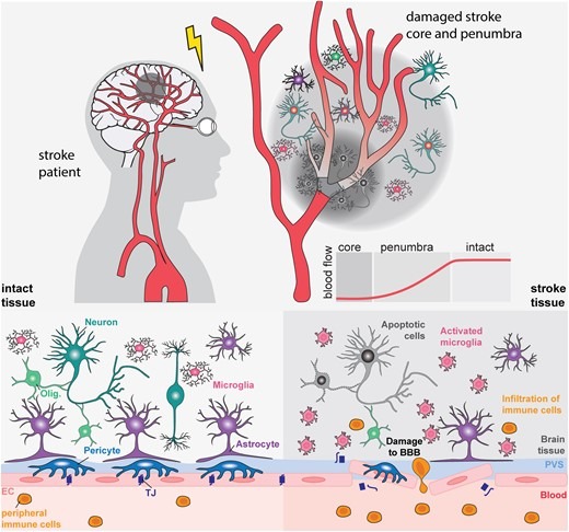 圖1:中風(fēng)的病理生理學(xué) 圖1:中風(fēng)的病理生理學(xué)
