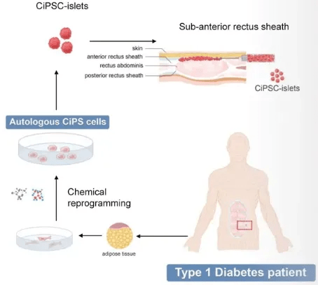 干細胞技術將成為糖尿病治療的新里程碑