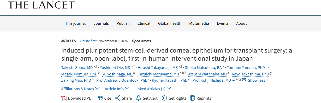 《誘導(dǎo)性多能干細胞來源的角膜上皮用于移植手術(shù)：日本的一項單臂、開放標簽、首次人體介入研究》