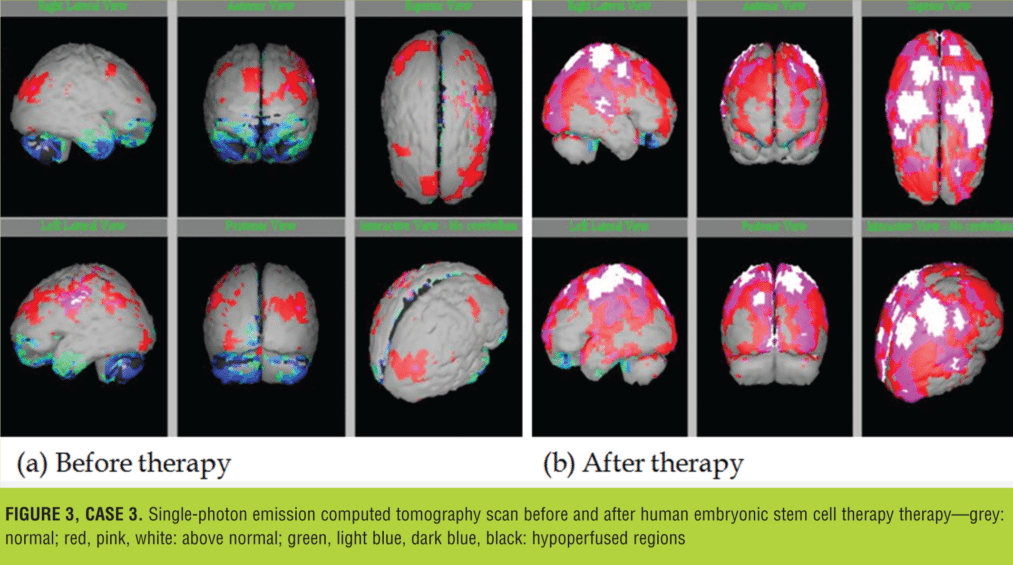 與之前的掃描結(jié)果相比，2014 年 1 月 9 日的 SPECT 掃描顯示腦灌注流正常（圖 3）