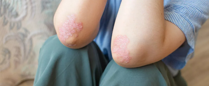 干細(xì)胞治療銀屑病：如何實(shí)現(xiàn)從短期銀屑病面積減少到長(zhǎng)期皮膚恢復(fù)正常？