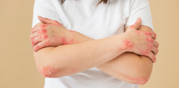 干細胞治療系統性紅斑狼瘡：如何實現從短期的疾病癥狀緩解到長期的多器官功能改善？