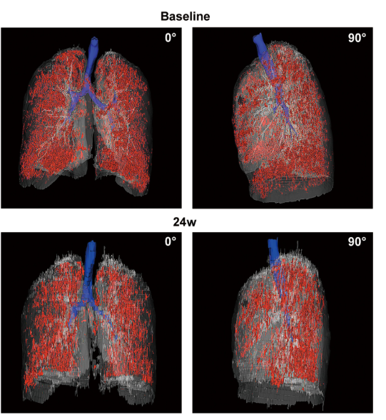 患者 #2902 自體 P63 細胞移植前和后 24 周連續肺部 CT 圖像的三維可視化。 患者 #2902 自體 P63 細胞移植前和后 24 周連續肺部 CT 圖像的三維可視化。