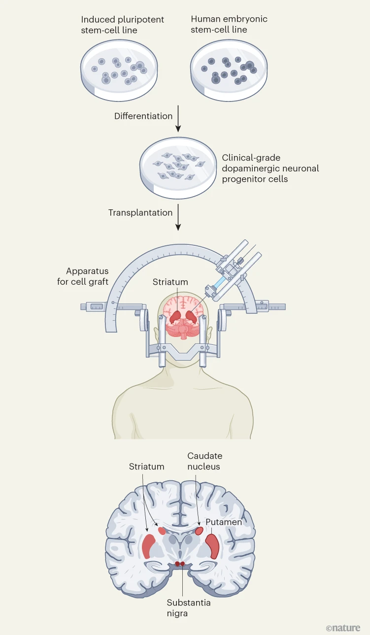 圖1：帕金森病的干細胞療法。