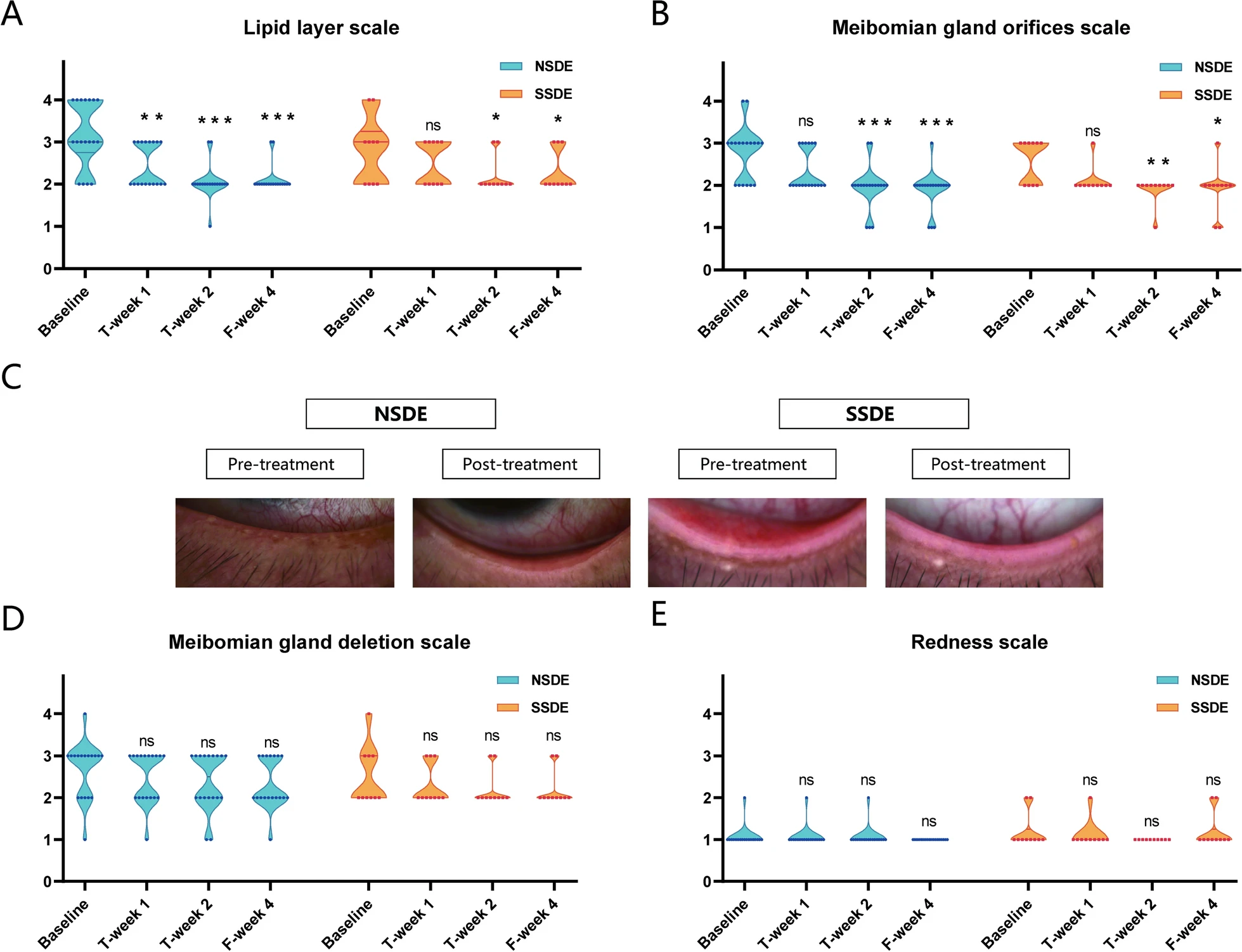 圖3：NSDE和SSDE組基線、T第1周、T第2周和F第4周的脂質(zhì)層、瞼板腺和紅斑量表。