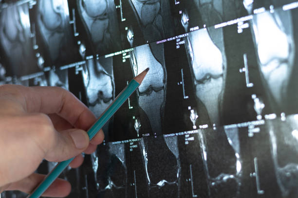 4種細胞療法運用免疫調節和再生機制為治療骨科疾病開辟了新方向