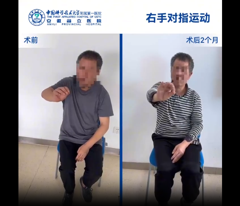 國內誘導多能干細胞療法新突破：首例早發型帕金森病成功給藥，當天即可行走