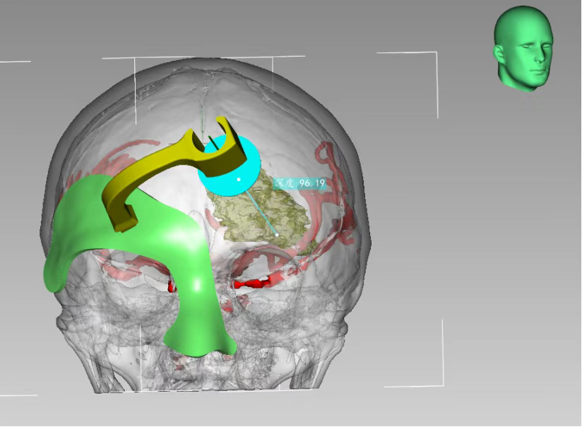 3D打印技術(shù)定位下腦內(nèi)血腫穿刺術(shù)