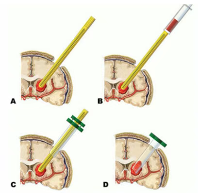神經(jīng)內(nèi)鏡輔助下腦內(nèi)血腫清除術(shù)示意圖